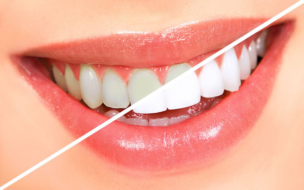 سفید کردن دندان با طب سنتی