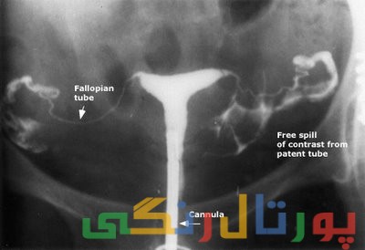 هیستروسالپنگوگرافی چیست؟