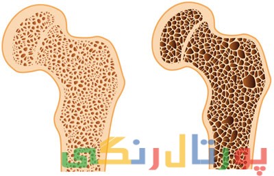 بهترین درمان برای پوکی استخوان