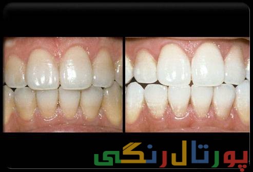 اطلاعات کامل درباره بلیچینگ دندان (سفید کردن دندان)