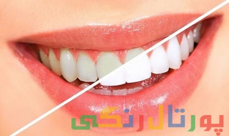 اطلاعات کامل درباره بلیچینگ دندان (سفید کردن دندان)