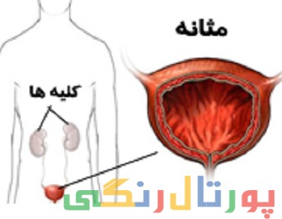 دلایل تکرر ادرار و عفونت مثانه چیست؟