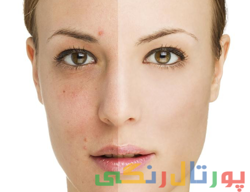 معرفی یک قرص برای رفع جای جوش