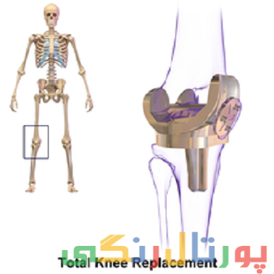 اطلاعات کامل درباره تعویض مفصل زانو