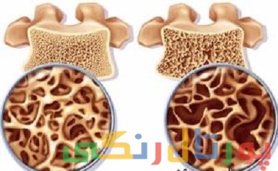 کشف روش نوین پیشگیری از پوکی استخوان