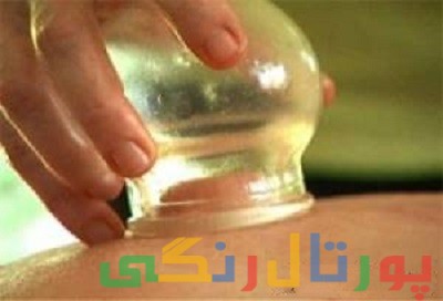 این افراد حجامت نکنند!