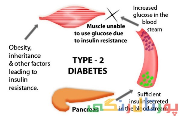 دیابت نوع 2