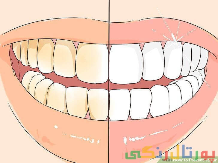 پاکسازی دندان‌ها به طور حرفه‌ای